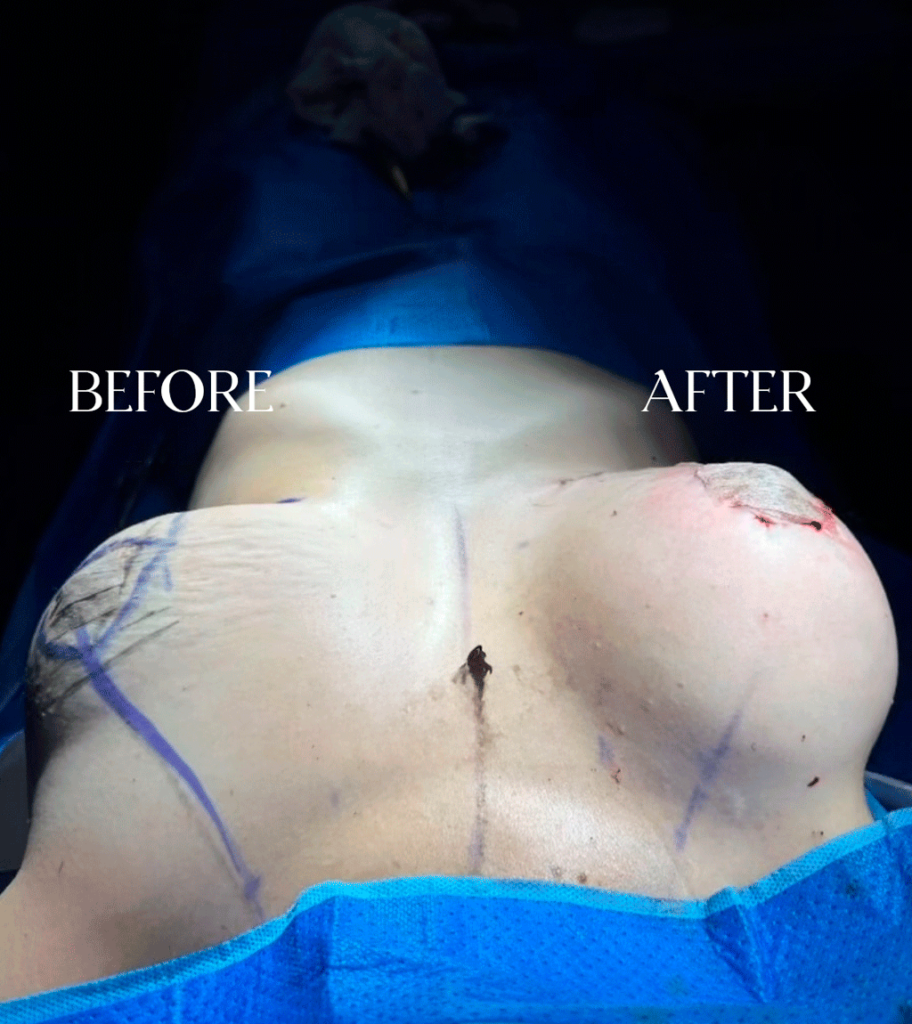 Plastic Surgery Recovery Dominican Republic