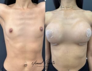 Natural results breast augmentation Dominican Republic before after
