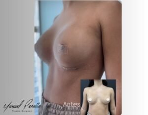 Natural results breast augmentation Dominican Republic before after