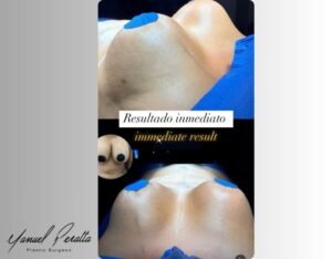 breast reduction dominican republic